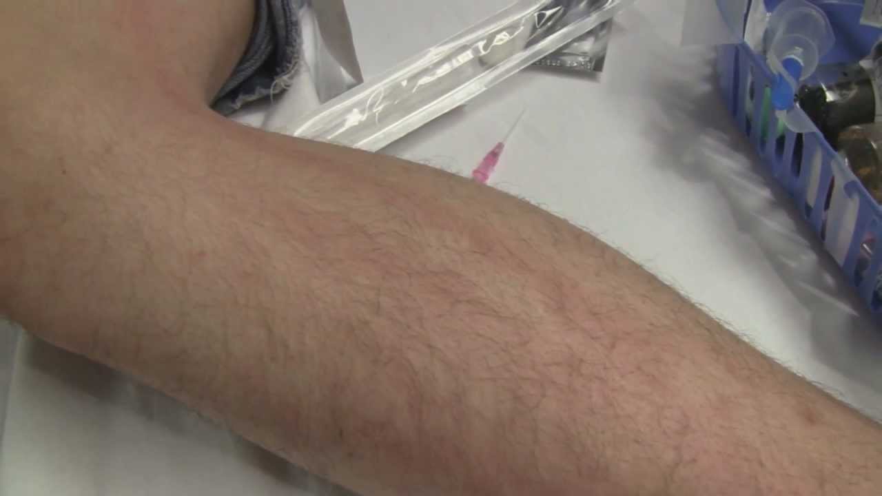 Leg Lymphangitis Thumbnail