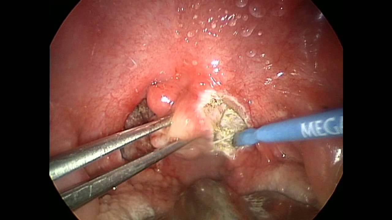 Tonsillectomy explained Thumbnail