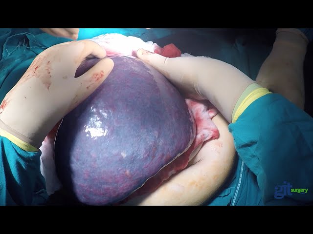 Open splenectomy of a patient with huge splenomegaly and hypersplenism by Dr Abd-Elmonem Nagy Gopro Thumbnail