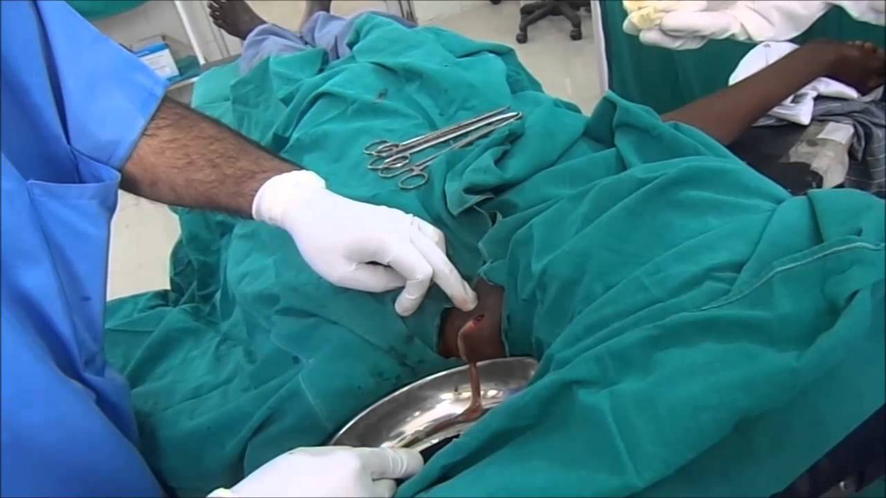 Abscess in Lymph Gland at Neck Drainage Thumbnail