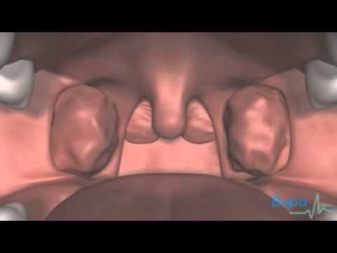Adenoid and tonsil removal Thumbnail